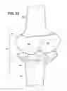Fig. 08 - Artificial wear resistant plug for mounting to existing joint bone