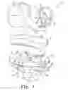 Fig. 02 - PROSTHESIS WITH CUT-OFF PEGS AND SURGICAL METHOD