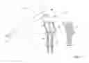 Fig. 06 - Method of determining shape of artificial cementless hip prosthesis stem