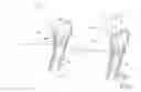Fig. 07 - Method of determining shape of artificial cementless hip prosthesis stem