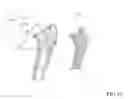 Fig. 20 - Method of determining shape of artificial cementless hip prosthesis stem