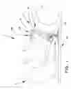 Fig. 02 - Airway positioning device