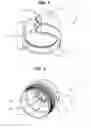 Fig. 05 - Filter cap additive delivery system