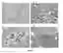 Fig. 06 - Malignancy-risk signature from histologically normal breast tissue