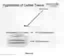 Fig. 31 - Malignancy-risk signature from histologically normal breast tissue
