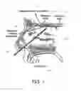 Fig. 02 - Method and apparatus for weight control by olfactory nerve ablation