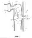 Fig. 06 - Temporary ostomy appliance