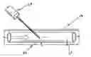 Fig. 01 - DEVICE AND METHODS TO FACILITATE CANNULATION AND PREVENT NEEDLE PUNCTURE BLEEDING OF AN ARTERIOVENOUS FISTULA