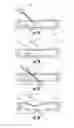 Fig. 03 - DEVICE AND METHODS TO FACILITATE CANNULATION AND PREVENT NEEDLE PUNCTURE BLEEDING OF AN ARTERIOVENOUS FISTULA