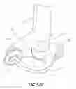 Fig. 35 - Vertebral facet joint drill and method of use