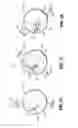 Fig. 48 - Endoscopic Stitching Devices