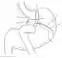Fig. 01 - IMPLANTABLE RESTRICTION DEVICE WITH SPACER