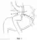 Fig. 02 - IMPLANTABLE RESTRICTION DEVICE WITH SPACER