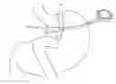 Fig. 01 - IMPLANTABLE RESTRICTION DEVICE WITH PROTECTIVE MEMBER