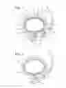 Fig. 03 - IMPLANTABLE RESTRICTION DEVICE WITH PROTECTIVE MEMBER