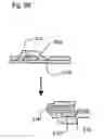 Fig. 20 - Bioerodible self-deployable intragastric implants