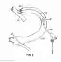 Fig. 02 - Method for treating a target site in a vascular body channel