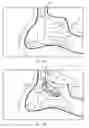 Fig. 03 - Device for remodeling the uncinate process
