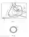 Fig. 07 - Device for remodeling the uncinate process