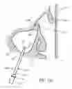 Fig. 25 - Device for remodeling the uncinate process