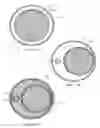 Fig. 28 - Device for remodeling the uncinate process
