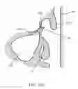 Fig. 37 - Device for remodeling the uncinate process