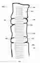 Fig. 02 - Spinal therapy device with fixated distraction distance