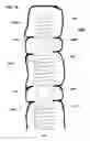 Fig. 16 - Spinal therapy device with fixated distraction distance