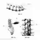 Fig. 02 - SPINOUS PROCESS SPACER AND IMPLANTATION PROCEDURE