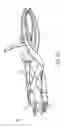 Fig. 05 - ARTHROPLASTY REVISION DEVICE AND METHOD