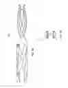 Fig. 11 - ARTHROPLASTY REVISION DEVICE AND METHOD