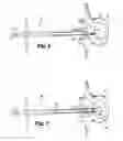 Fig. 05 - Method and apparatus for delivering an intervertebral disc implant