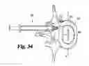 Fig. 22 - Method and apparatus for delivering an intervertebral disc implant