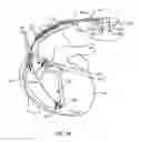 Fig. 37 - Switched diverter circuits for minimizing heating of an implanted lead in a high power electromagnetic field environment