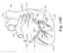 Fig. 07 - Integrated lead for applying cardiac resynchronization therapy and neural stimulation therapy