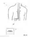 Fig. 02 - Dorsal column stimulation therapy