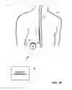 Fig. 03 - Dorsal column stimulation therapy