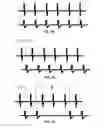 Fig. 09 - Dorsal column stimulation therapy