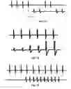Fig. 10 - Dorsal column stimulation therapy