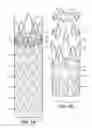 Fig. 02 - Low Profile Prosthesis