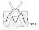 Fig. 08 - Low Profile Prosthesis