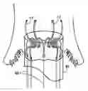 Fig. 01 - Minimally invasive heart valve replacement