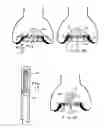 Fig. 06 - Minimally invasive heart valve replacement