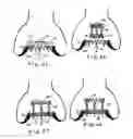 Fig. 07 - Minimally invasive heart valve replacement