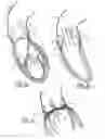 Fig. 02 - Implantable prosthetic valve for treating aortic stenosis