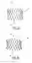 Fig. 04 - Implantable prosthetic valve for treating aortic stenosis