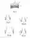 Fig. 07 - Implantable prosthetic valve for treating aortic stenosis