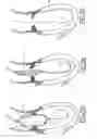 Fig. 14 - Implantable prosthetic valve for treating aortic stenosis