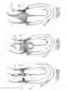Fig. 15 - Implantable prosthetic valve for treating aortic stenosis
