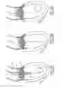 Fig. 16 - Implantable prosthetic valve for treating aortic stenosis